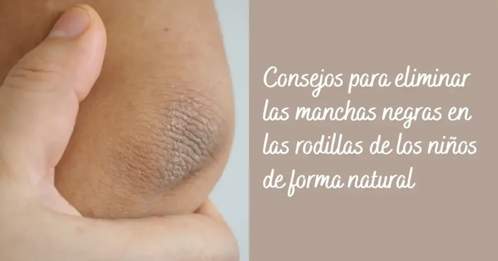 Consejos para eliminar las manchas negras en las rodillas de los niños de forma natural